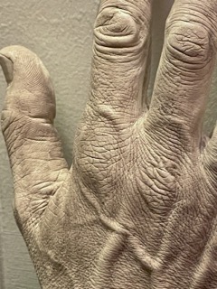 close up of back of the hand cast looking over the knuckles 